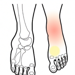 Nöropatik osteoartropati